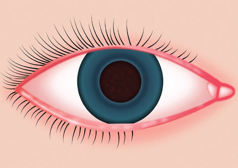blepharitis wimpernverlängerung
